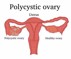 Polycystic ovary